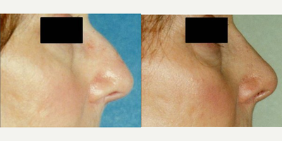 Rhinoplasty before and after photo