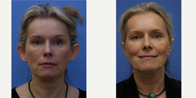 Ear Surgery before and after photo