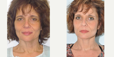 Facelift before and after photo