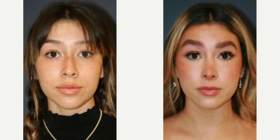 Rhinoplasty before and after photo