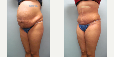 Tummy Tuck before and after photo