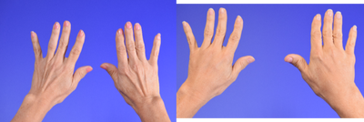 Dermal Fillers before and after photo