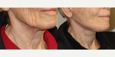 Facelift before and after photo