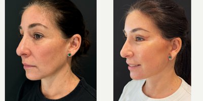 Facial Fat Transfer before and after photo