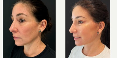 Facial Fat Transfer before and after photo
