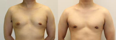 Gynecomastia Surgery before and after photo