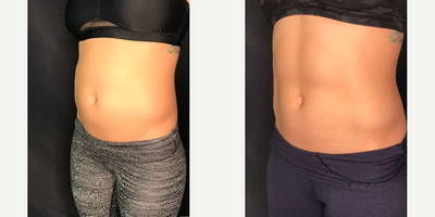 SculpSure before and after photo
