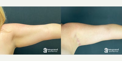 Arm Lift before and after photo