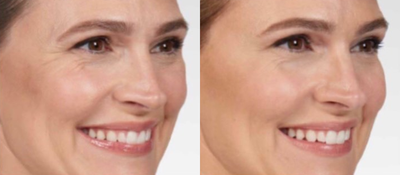 Botox before and after photo