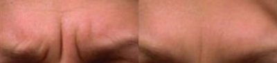Botox before and after photo