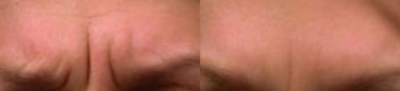 Botox before and after photo