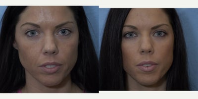 Juvederm before and after photo