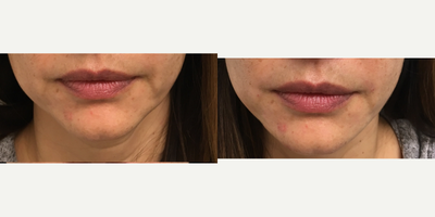 Restylane Defyne before and after photo