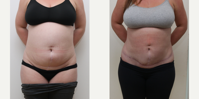 Tummy Tuck before and after photo