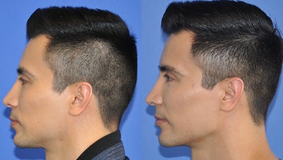 Chin Implant before and after photo