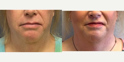 Lip Surgery before and after photo