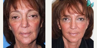 Neck Lift before and after photo