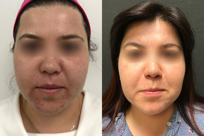 ProFractional Laser before and after photo