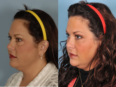 Restylane before and after photo