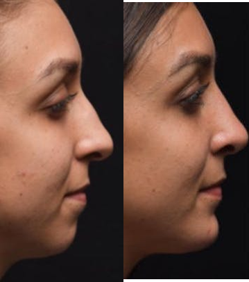 Revision Rhinoplasty before and after photo