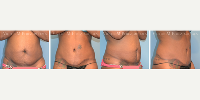 Tummy Tuck before and after photo