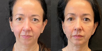 Botox before and after photo