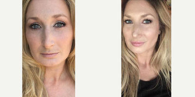 Botox before and after photo