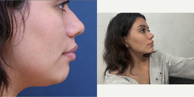 Chin Filler before and after photo
