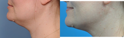 Chin Liposuction before and after photo