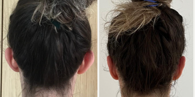 Ear Surgery before and after photo