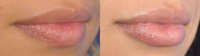 Lip Fillers before and after photo
