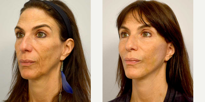 Mini Facelift before and after photo