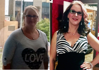 Tummy Tuck before and after photo