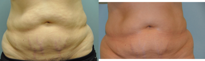 CoolSculpting before and after photo