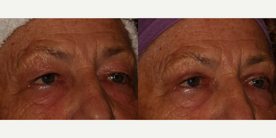 Eyelid Surgery before and after photo