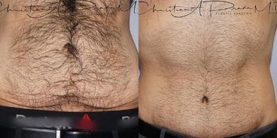 Tummy Tuck before and after photo