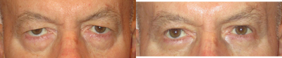 Brow Lift before and after photo
