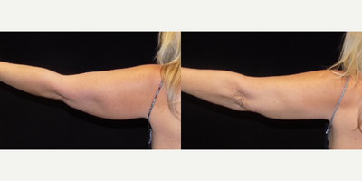 CoolSculpting before and after photo