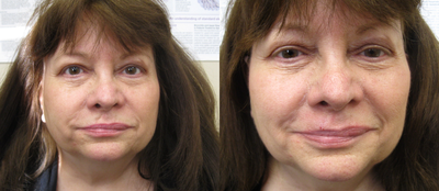 Dermal Fillers before and after photo