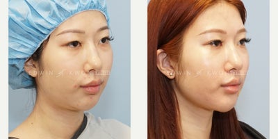 Liposuction before and after photo