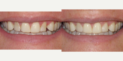 Tooth Repair before and after photo