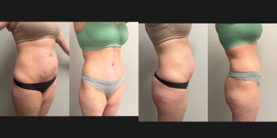 Tummy Tuck before and after photo
