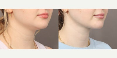 Vaser Liposuction before and after photo