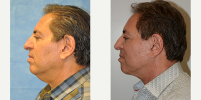 Neck Lift before and after photo