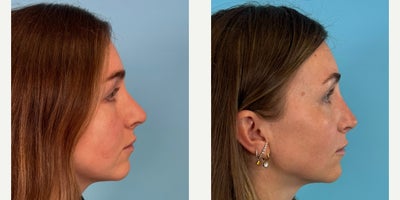 Septoplasty before and after photo