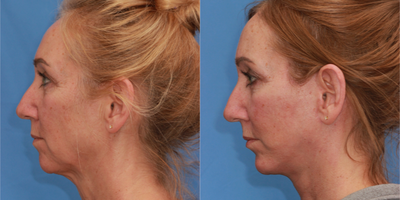Deep Plane Facelift before and after photo