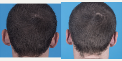 Ear Surgery before and after photo
