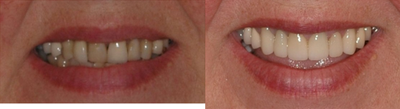 Smile Makeover before and after photo