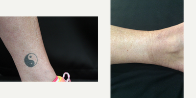 Tattoo Removal before and after photo