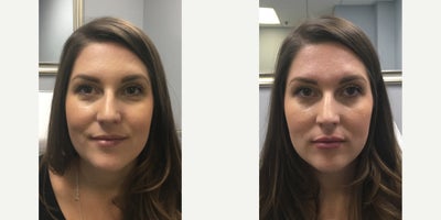 Botox before and after photo
